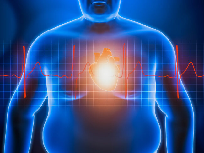 Obesity and heart disease illustration