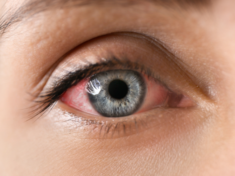 Eye irritation inflamation uveitis