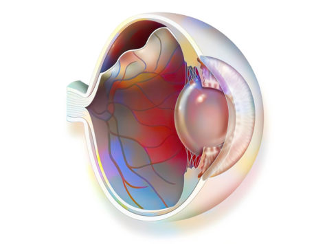 Eye retinal detachment