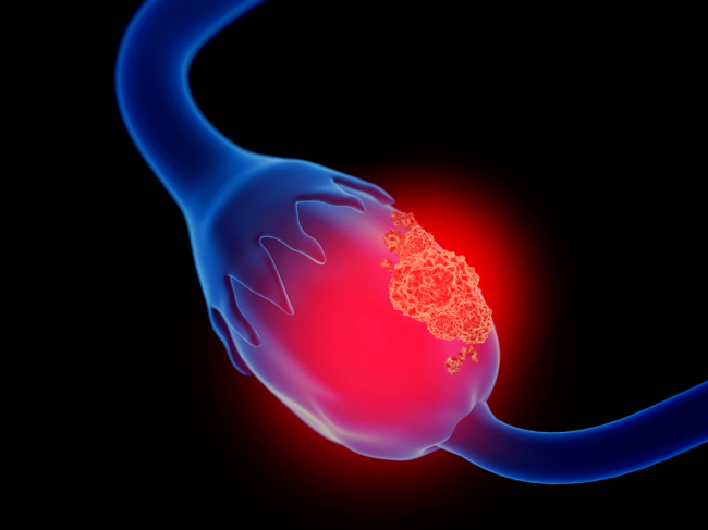 3d illustration of ovarian cancer