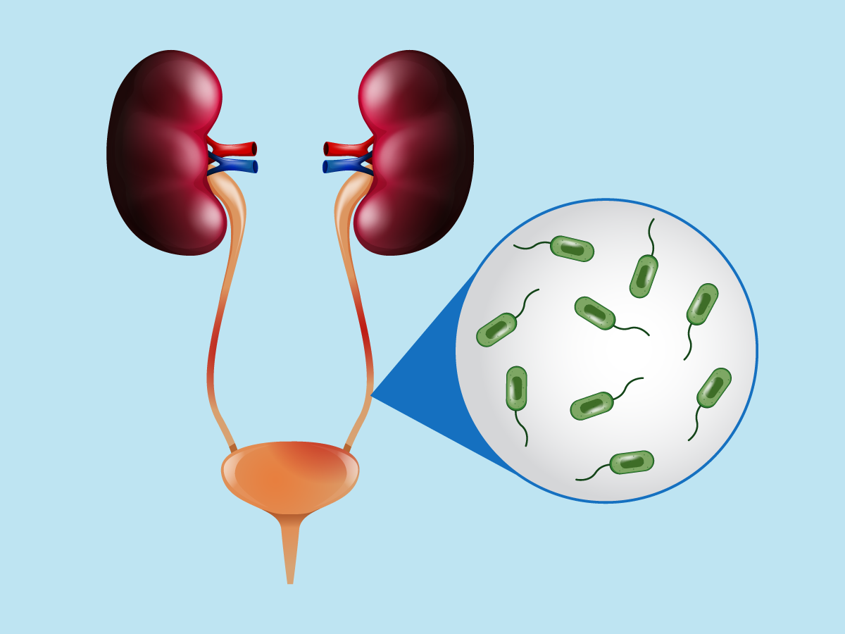 Chronic Urinary Tract Infection vs. Recurrent UTI Symptoms